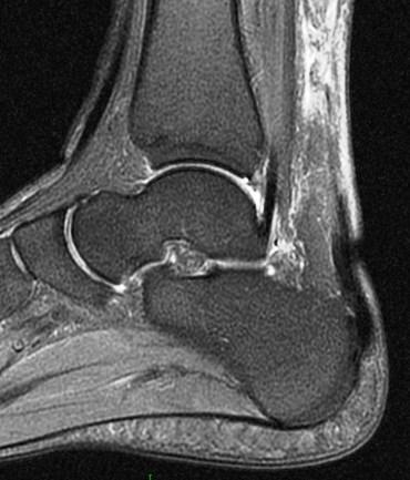 Figure 2 for case Achilles tendon tear and calcaneonavicular coalition (RID3801)(RID3184)